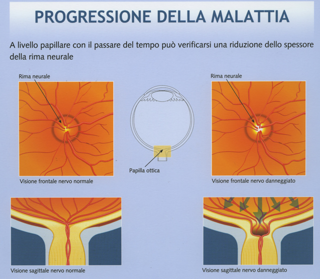 Progressione della retinopatia diabetica sul campo visivo